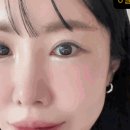 눈썹달 | 의정부성형외과 눈썹하거상술 한달후 후기