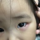 26개월 아기 다래끼 치료, 세종시 서울삼성안과 방문기