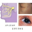 오타 모반[Ota like Melanosis] 이미지