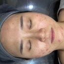 늘곁한의원 | 수원 후한의원 여드름,색소침착 내돈내산 후기