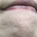 노은산부인과의원 | 내돈내산 대전 노은동 피부과에서 염증주사 및 여드름 약 후기 (가격,전후비교)