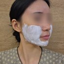프라임 | 압구정피부과 울쎄라프라임 내돈내산 후기 (수면마취X,다운타임,울쎄라 비교)