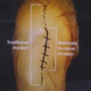 최소절개술로 피부 및 근육손상 최소화 이미지