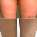 바램과믿음 | 허벅지 안쪽살 지방파괴주사 고민하다가 맞고 온 솔직 후기