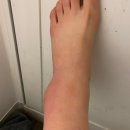 아나파한의원 | 관악산 등산 후 찾은 필수템, 아나파 미세전류 저주파 발마시지기