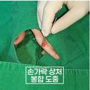 손가락 열상 상처 봉합 후기[병원 성형외과 정형외과]