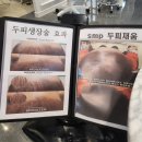 브니엘 | [구미 탈모관리] 브니엘뷰티 탈모집중케어 솔직후기