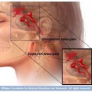 동맥류 에대해 공부좀 해봅시다~♡ 이미지