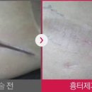 켈로이드 흉터 원인 치료 방법 수술 이미지