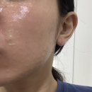 덜아픈세상 | [내돈내산] 세상쫄보가 리쥬란 처음 받아본 후기