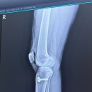 서울나우병원 | [평촌나우병원 수술] 우측 전방십자인대 파열 후 재건술 자가건 수술 후기 (D+4 수술 전후 mri 비교 및...