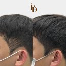 국제두피탈모 | 남자 정수리탈모 고민, 서울 잠실두피문신 후기로 알아보세요