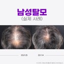 양재내과의원 | 탈모약 부작용 이후 10년 방치... 양재역탈모병원 현실적인 치료 방향