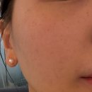 브이 | 대구시지피부과 엑셀브이후기 잡티제거레이저 내돈내산