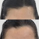 루시드닷(LUCIDDOT) | 자연스러운 헤어라인 교정✨️ 금천구SMP 전문 탈모커버 "루시드닷 (LUCIDDOT)"