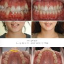 오수치과의원 | 클리피씨 데이몬, 나에게 맞는 선택방법은?