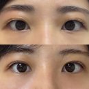 압구정페이스라인성형외과의원 | 압구정 아몬드성형외과 내돈내산 자연유착 쌍수 한달 6주차 후기