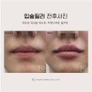 유진성형외과의원 | 하남필러 잘하는곳, 수술보다 만족도 높으려면?