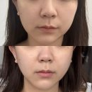 눈, 여기다 | 옥길윤곽관리 제이알테라피 후기, 수기관리는 여기다! 이중턱 정리하고 턱선 살린 날