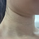 예쁨주의쁨의원 강남본점, 예쁨목주사 1주일차 솔직 후기 (가로 목주름 개선 + 부작용 체크)