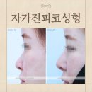 코원성형외과의원 | 자가진피코성형, 자가조직코수술이라던데… 다 같은 건가요?