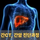 조영빌딩 | 간 CT 병원, &#39;영상촬영 후기&#39;로 본 간암 진단 과정