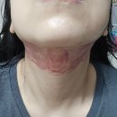 뷰티온의원 강서점 | 스킨보톡스 제오민 그리고 인모드FX 시술 후기 2 / 인모드 멍 빨리 빼는법