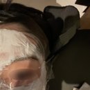 그린스타약국 | 흉터 치료 레이저 후기 | 여드름 흉터 시술 후기 | 브이빔 &amp; 스타워커 4회차 후기 | 여드름 없애는 법