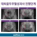 고관절인공관절수술 어디서 하느냐가 인생을 좌우한다. 대퇴골두무혈성괴사, 고관절인공관절, 강서구 웰튼병원 이미지