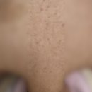 서현농협 앞 | 대전대동피부관리 서현스킨앤바디 등여드름 약초필 관리 후기!