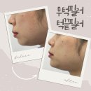 경우 | 무턱필러/턱끝필러 후기, 만족도 높은 경우의 공통점