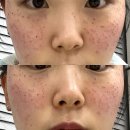 연제골프장 | 부산 연산동 H뷰티엠 콜드플라즈마로 피부 잡티 주근깨 제거 후기