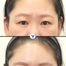 내시경 이마거상술, 회복과정이 궁금하다면? (경과별 전후사진)