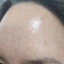 이마 | 서대문피부과 명동 쥬베룩 이마 후기