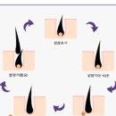 바르는 미녹시딜 부작용 쉐딩현상 대처방법은 이미지