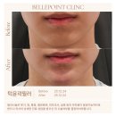 닥터박의원 | 턱필러 총 정리 : 무턱 / 시술전후 / 부작용 / 가격 / 유지기간 / 용량 / 녹이기