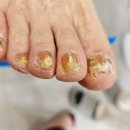 레푸스 방이역점 | 송파 무좀발톱으로 유명한 레푸스 방이역점에서 관리받기