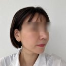 멍스낵 | 청담울쎄라300샷으로 턱선리프팅하기 울쎄라멍 울쎄라비용공유