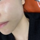 데일리의원 | 청담피부과 오가나셀의원 고우리 스킨부스터 후기｜다운타임 거의 없는 스킨부스터 추천