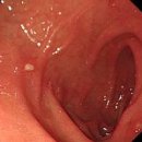 십이지장 궤양 증상 원인 십이지장염, 십이지장 암 이미지