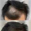 선헤어라인 이미지