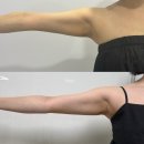 양이멍이 | 압구정역 뉴핏 팔뚝 지방분해주사 내돈내산 7일차 후기 ᵕ̈ ˖⋆