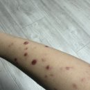 바이러스 | 장미색비강진,바이러스 발진 후기 (발진 초기-완쾌)