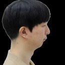 Dr. 한 치과의원 | 무턱인데, 턱끝 수술 없이 교정한 후기