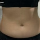(주)SPL | [공지] 내돈내산💰 2회차 부산 지방분해주사, SPL 주사, 복부, 후기, 통증