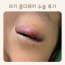 내원어린이집 | 세돌아기 아기 콩다래끼 수술 당일 후기 &amp; 회복 기록