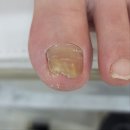 회정로 | 양주 옥정 내성발톱 발톱무좀 동시에 관리받기 대만족 굿네일