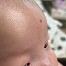 합정오아시스약국 | 마포공덕 에스앤유피부과 신생아 아기 혈관종 레이저 치료 후기(+주차, 화장실, 수유실 정보)