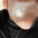 루비 | 압구정 루비레이저 내돈내산 후기, 당일~3일차 / 미리 알고가면 좋은 것들, 통증