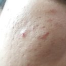 채운 | 피부과한의원 곰보피부 새살 채운 후기